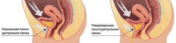 Безоперационная коррекция недержания мочи